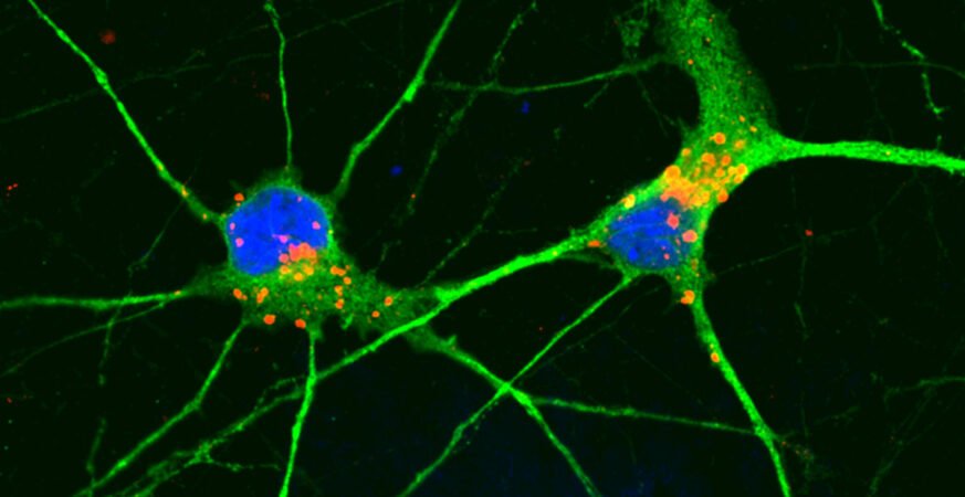 Could a Newly Discovered Type of Cellular Collapse Finally Explain How Dementia Destroys the Mind