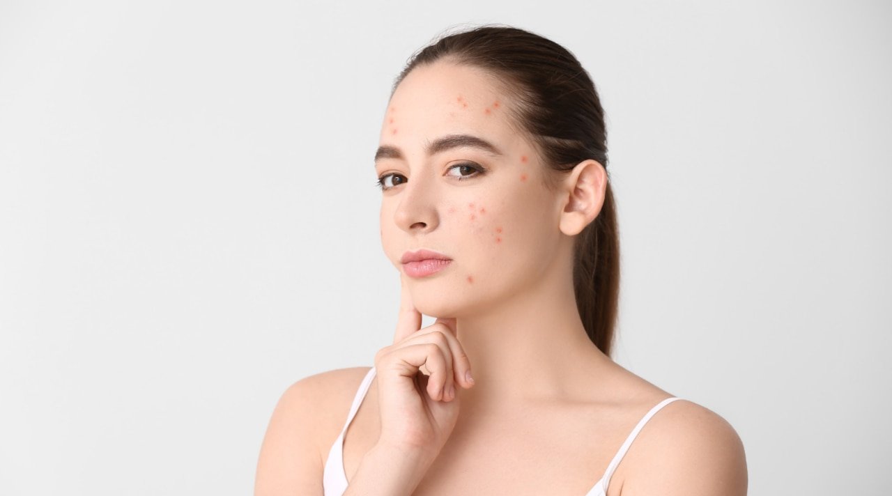 Is High Cortisol Face Really a Sign of Too Much Cortisol, or Has TikTok Got It Wrong